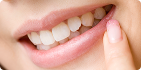 4.歯の審美治療
